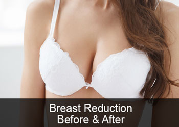 alexaderm breast reduction cream